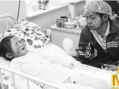 Дүрэлзсэн галаас аврагдсан ч, хүнд түлэгдсэн охин хагалгаанд орохоор болжээ