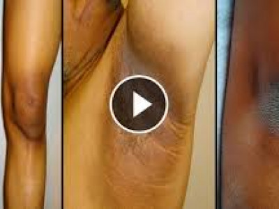 Харалсан суга,хөл, тохойноос гэрийн нөхцөлд төвөггүй салж болно