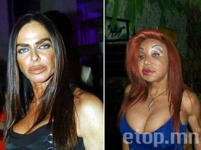 Шуналын балаг буюу гоо сайхны мэс заслын хохирогчид