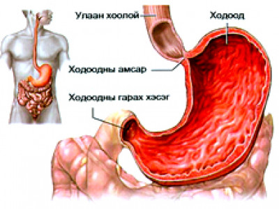 ХОДООДНЫ ӨВЧНИЙГ ЭДГЭЭХ МОНГОЛЫН ЭРТНИЙ АРГА