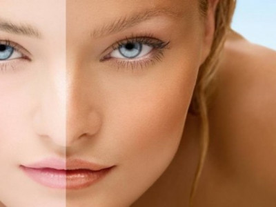 Наранд борлож, түлэгдсэн арьсыг цайруулж эмчлэх 7 арга