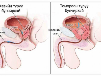 Ц.Ариунбаяр: Түрүү булчирхайн архагшсан өвчтэй эрчүүд Монголоор дүүрэн болсон