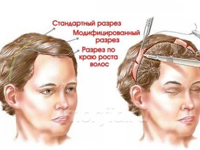 Броулифтинг гэж юу вэ, танд хэрэгтэй юү?