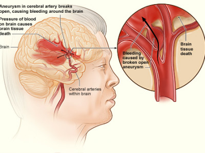 Архи тамхи, өөх тос, стрессээс үүдэн тархинд цус харваж байна 