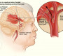 Архи тамхи, өөх тос, стрессээс үүдэн тархинд цус харваж байна 