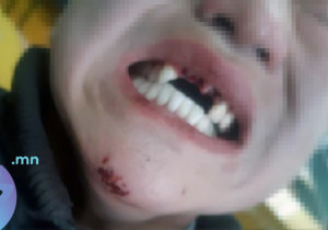 Наймдугаар ангийн хөвгүүд зодолдож, нэгнийхээ 4 шүдийг булгалжээ